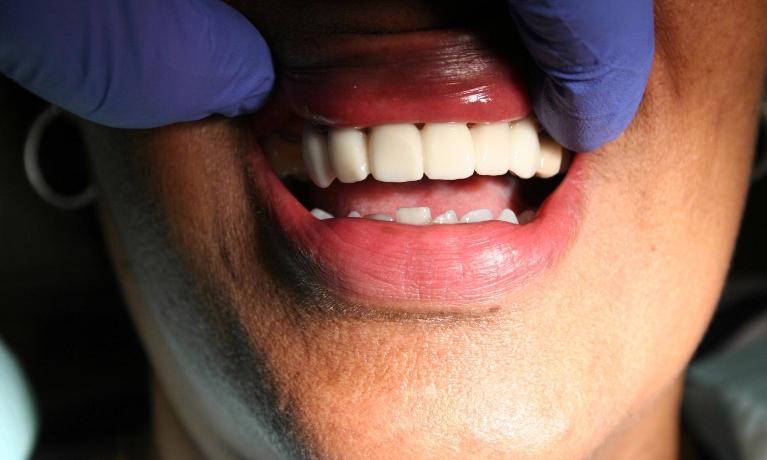 Anterior-Esthetics-After-Image