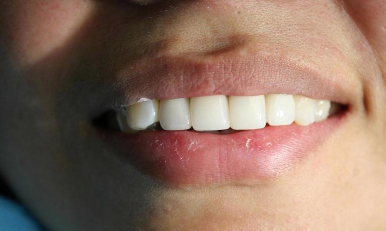 Anterior-Implants-After-Image