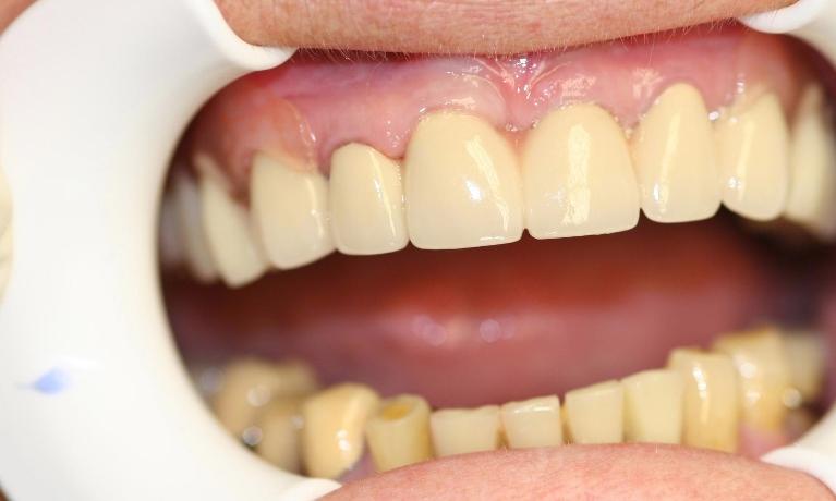 Anterior-Case-Esthetics-with-Valplast-Denture-After-Image