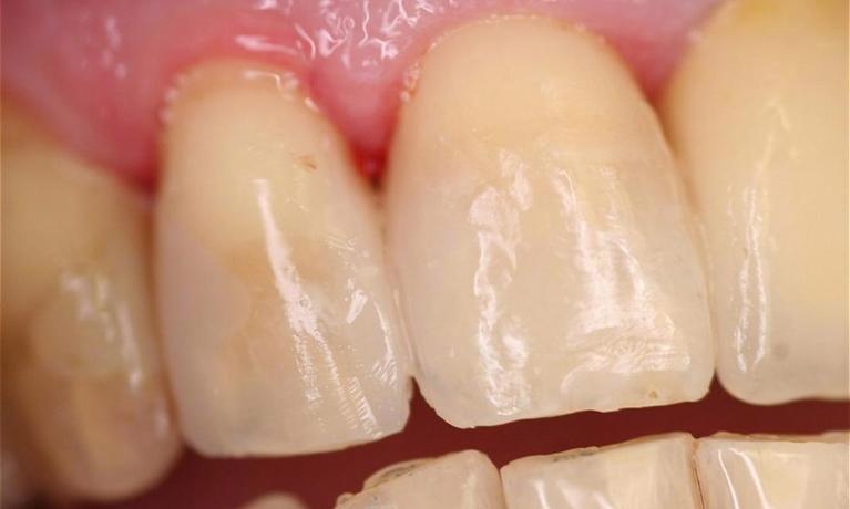 Bonding-White-Fillings-After-Image