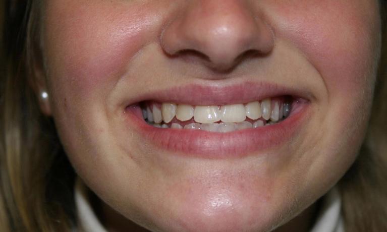 Invisalign-Case-and-Zoom-whitening-After-Image