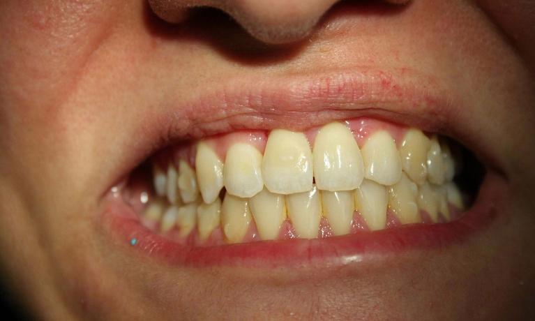 Invisalign-After-Image