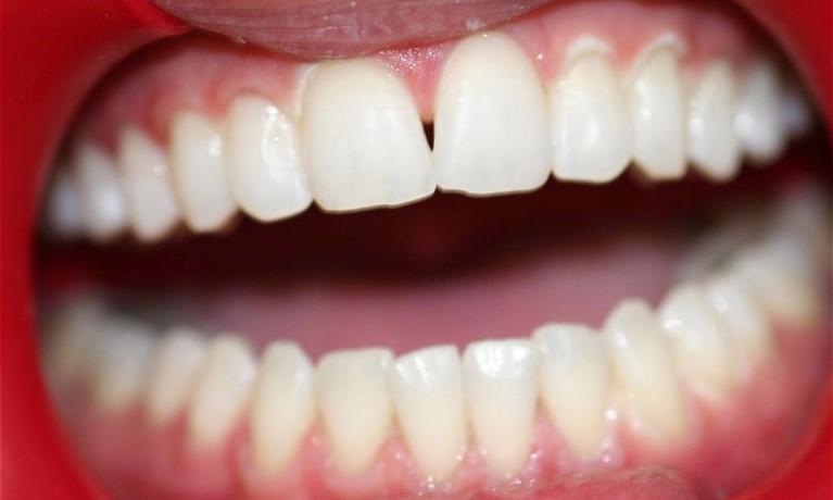 Kor-Whitening-After-Image
