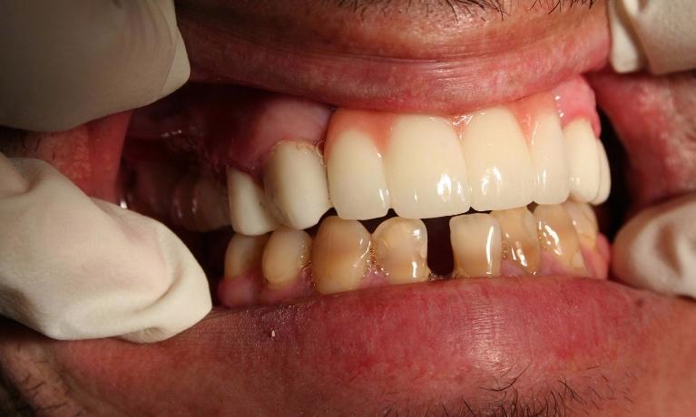 Upper-Bone-Grafting-and-Implants-After-Image