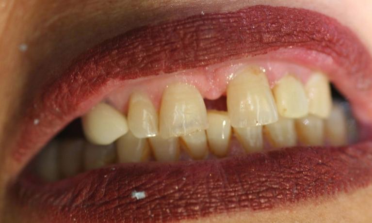Anterior-Esthetic-Bridge-with-Precision-Attachment-Denture-Before-Image