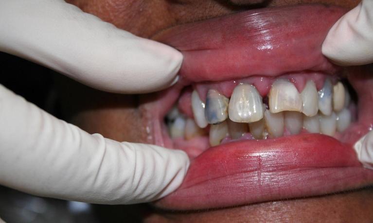 Anterior-Esthetics-Before-Image