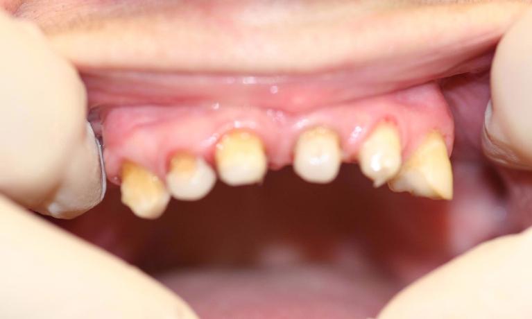 Anterior-Case-Esthetics-with-Valplast-Denture-Before-Image