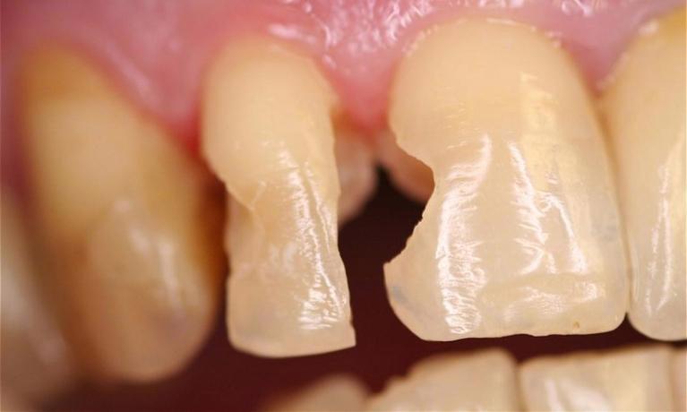 Bonding-White-Fillings-Before-Image