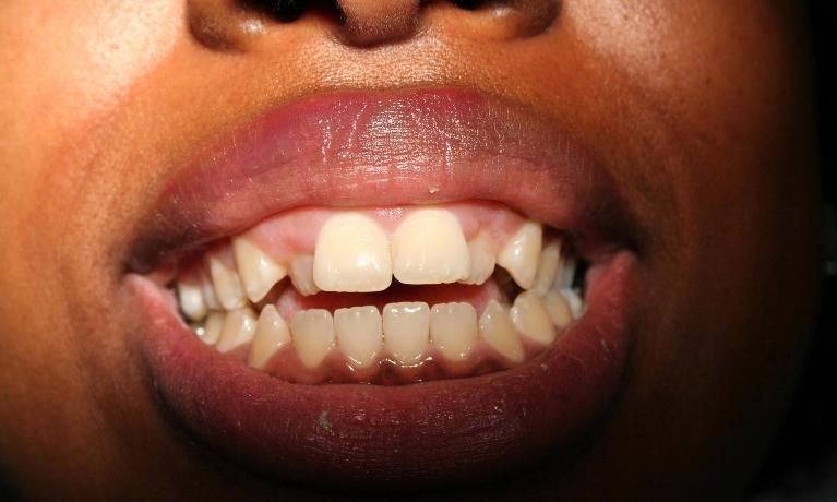 Esthetic-Crown-Lengthening-and-Invisalign-Before-Image