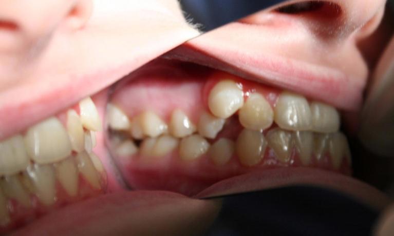 Invisalign-Case-and-Zoom-whitening-Before-Image
