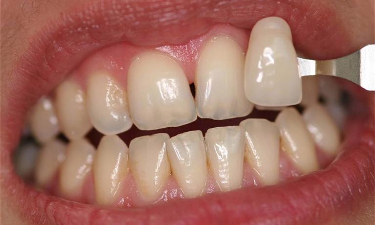 Kor-Whitening-Before-Image