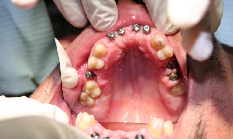 Upper-Bone-Grafting-and-Implants-Before-Image